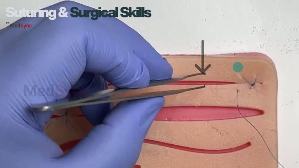 The Continuous Suture: The Fast Way